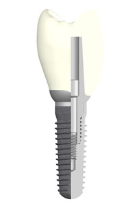 2. Schnitt durch ein Implantat