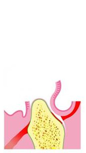 1. Zahnloser Kiefer im Querschnitt, Zahnfleisch eröffnet mit Sicht auf den Knochen